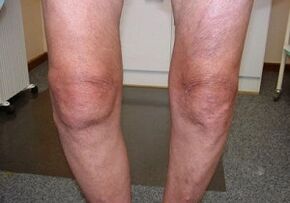 How to treat the arthrosis of the knee joint