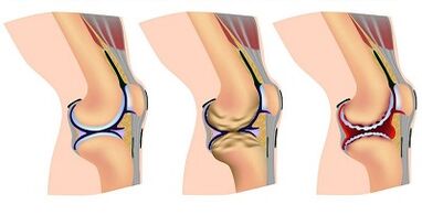 Development phase of the arthrosis of the knee joint