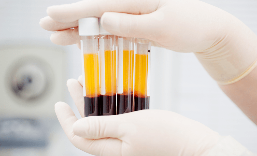 Platelet-rich plasma for PRP therapy for osteoarthritis